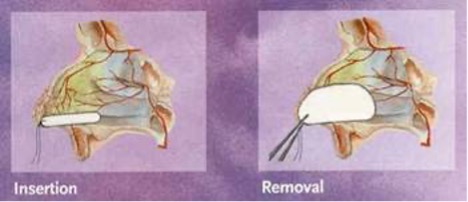 Epistaxis_CPG_Anterior packing